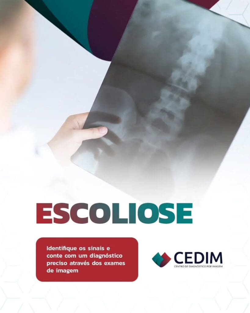 A escoliose é uma curvatura anormal da coluna vertebral que pode surgir na infância, adolescência ou na fase adulta. Muitas vezes, ela é silenciosa e só apresenta sintomas quando já está mais avançada. A escoliose é uma curvatura anormal da coluna vertebral que pode surgir na infância, adolescência ou na fase adulta. Muitas vezes, ela é silenciosa e só apresenta sintomas quando já está mais avançada.